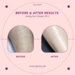 900,000 Flashes Laser IPL Hair Removal Device Glossy.pk