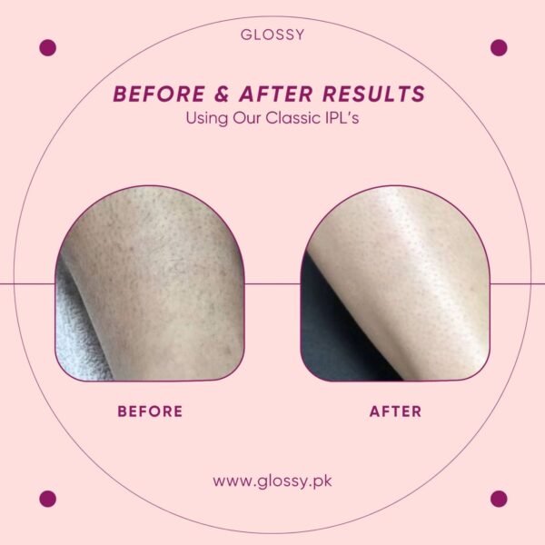 GLOSSY CLASSIC IPL LASER HAIR REMOVAL DEVICE anti-tarnish jewellery from Glossy.pk, Lahore