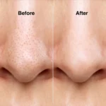 Glossy Aqua Vacuum Pore Cleaner | Mini Hydra Facial Device - Image 5