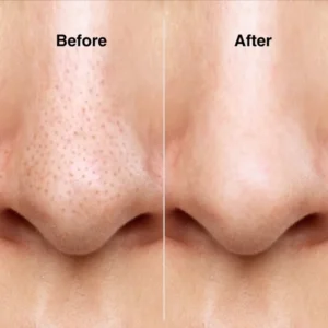 Glossy Aqua Vacuum Pore Cleaner (Mini Hydra Facial Device) product photo 4 | Glossy.pk Pakistan
